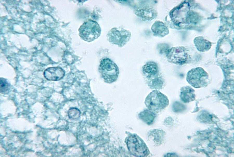 Naegleria fowleri